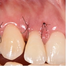 Puntos de sutura en periodoncia